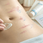 cicatrice sleeve avant après abdomen crème